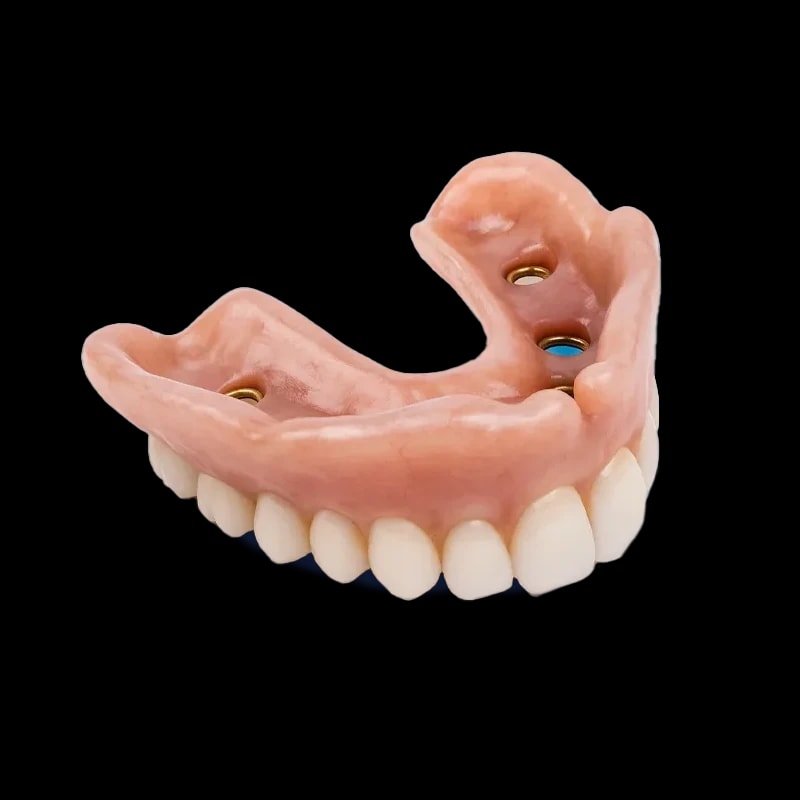 Implant-Retained